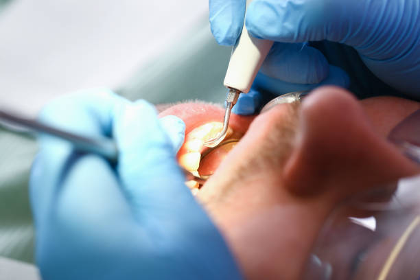 Best Emergency Tooth Extraction in Fox River Grove, IL