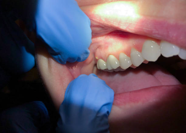 Best Emergency Gum Treatment in Fox River Grove, IL